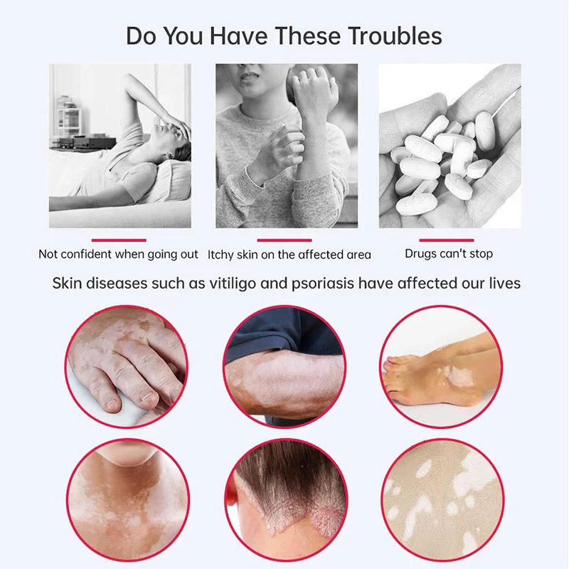 Skin Psoriasis Dermatitis Eczema Care Cream
