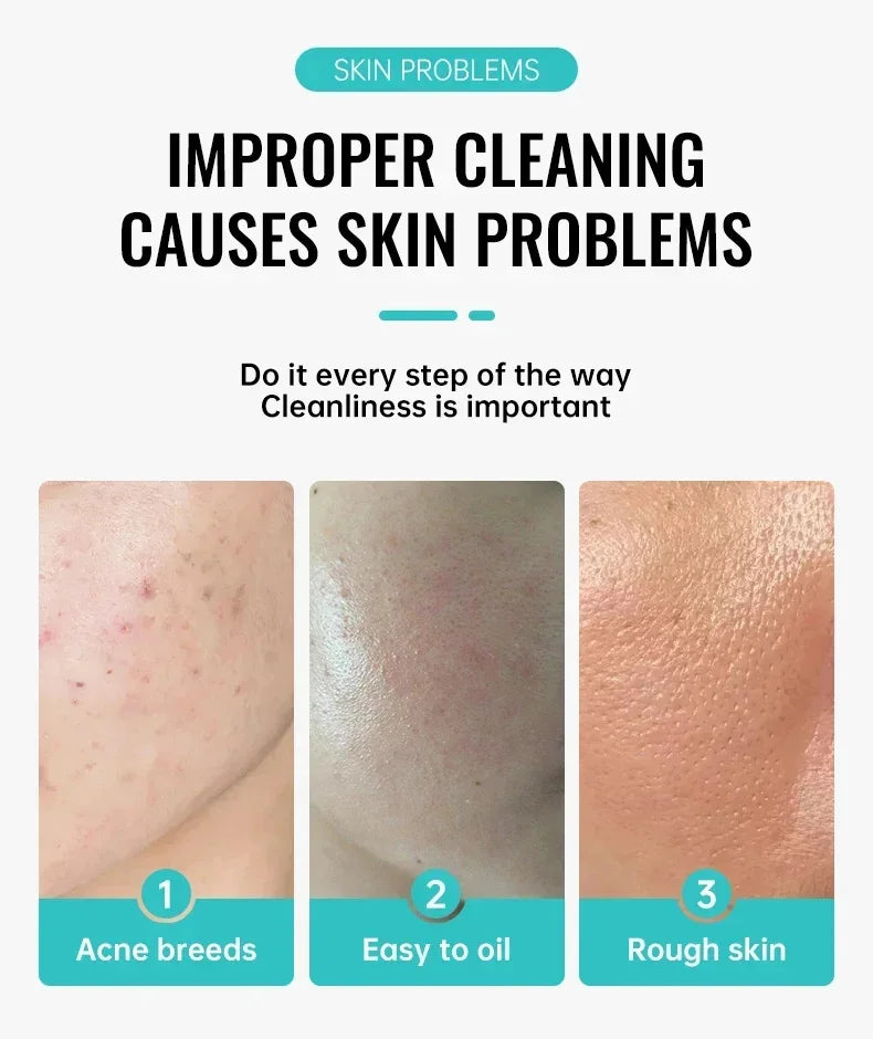 Salicylic Acid Acne Removal Cream