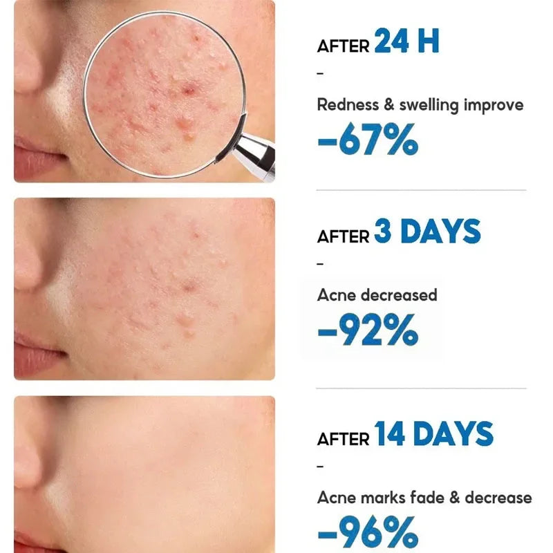 Salicylic Acid Acne Removal Cream