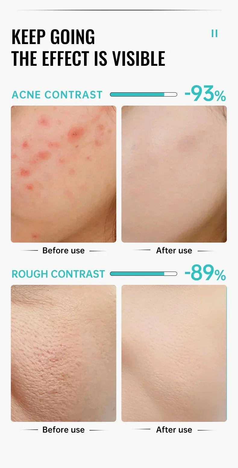 Salicylic Acid Acne Removal Cream