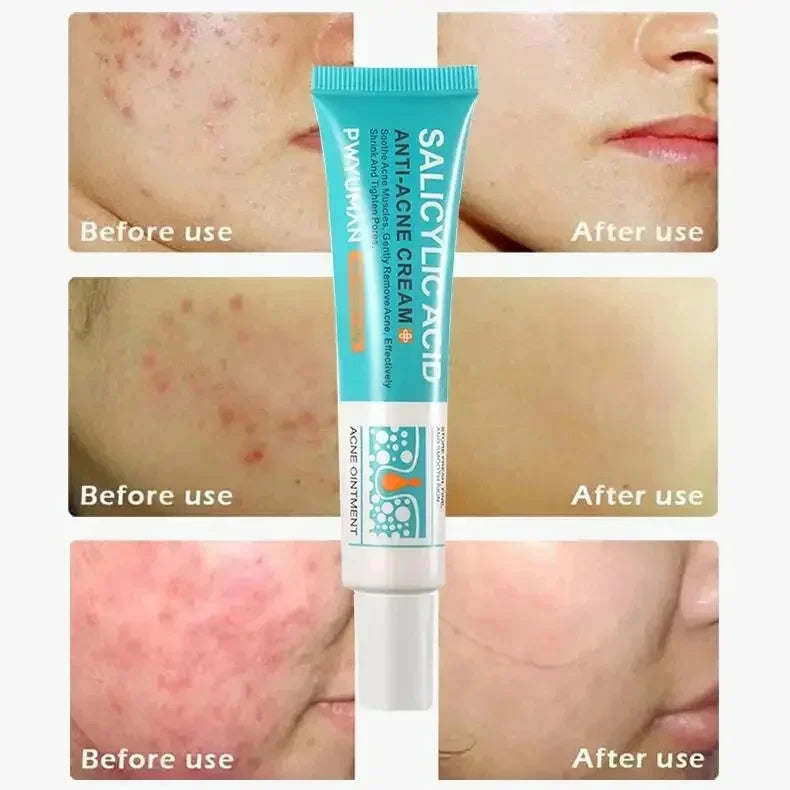 Salicylic Acid Acne Removal Cream