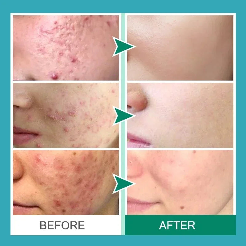 Salicylic Acid Acne Removal Cream