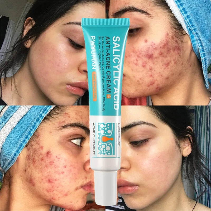 Salicylic Acid Acne Removal Cream