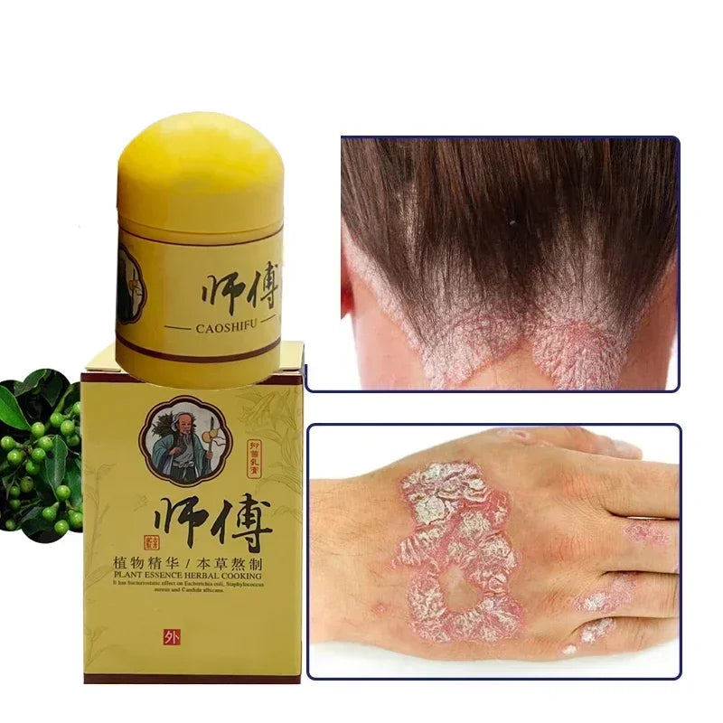 Skin Psoriasis Dermatitis Eczema Care Cream