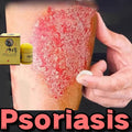Skin Psoriasis Dermatitis Eczema Care Cream