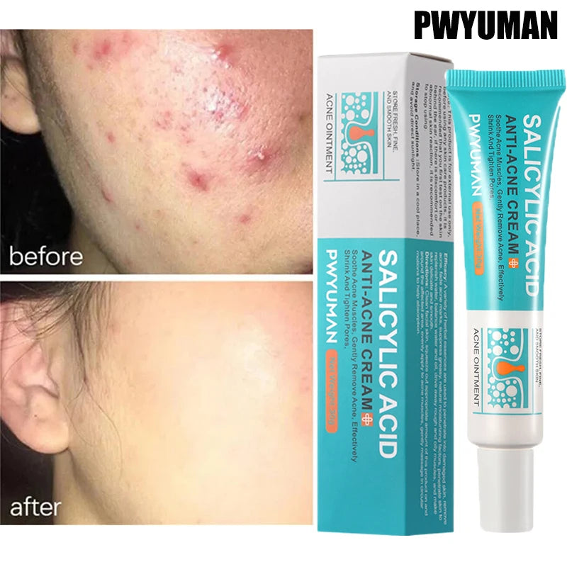 Salicylic Acid Acne Removal Cream