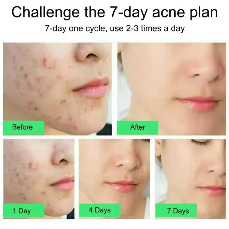 Salicylic Acid Acne Removal Cream