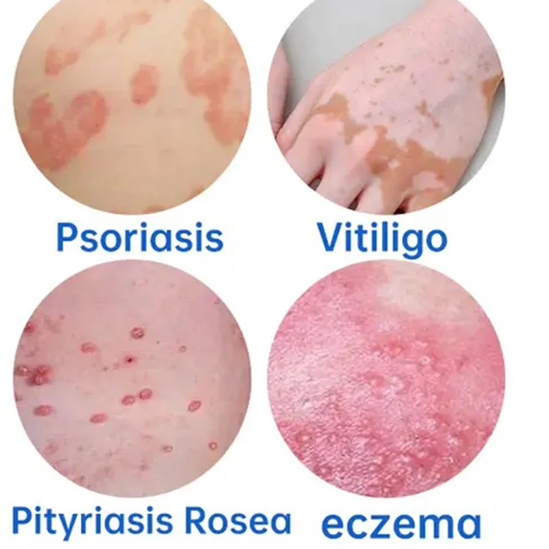 Skin Psoriasis Dermatitis Eczema Care Cream