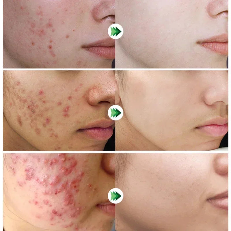 Salicylic Acid Acne Removal Cream