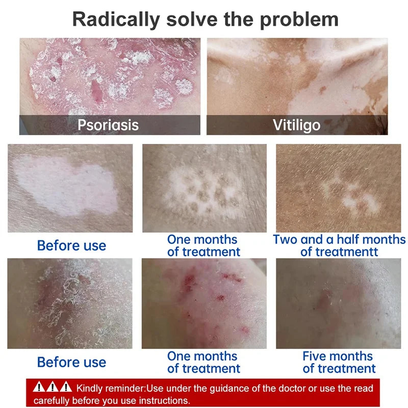 Skin Psoriasis Dermatitis Eczema Care Cream