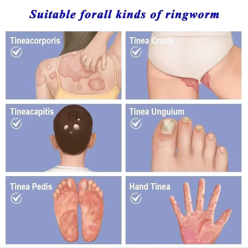 Skin Psoriasis Dermatitis Eczema Care Cream