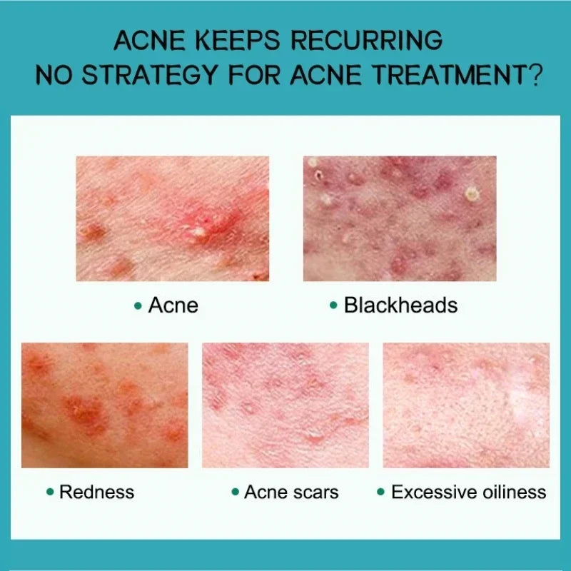 Salicylic Acid Acne Removal Cream