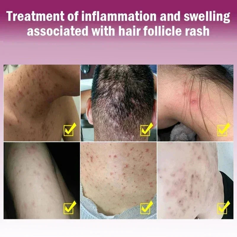 Skin Psoriasis Dermatitis Eczema Care Cream