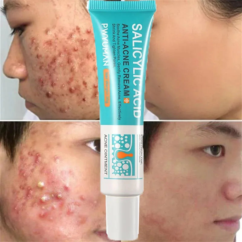 Salicylic Acid Acne Removal Cream