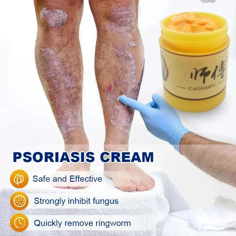 Skin Psoriasis Dermatitis Eczema Care Cream